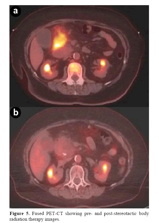 pancreas-post-stereotactic-body