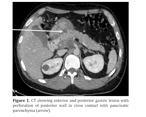 pancreas-posterior-gastric-lesion