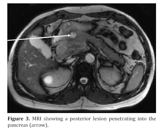 pancreas-posterior-lesion-penetrating