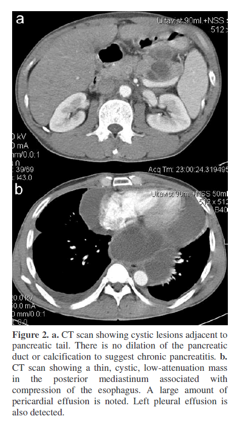 pancreas-posterior-mediastinum-associated