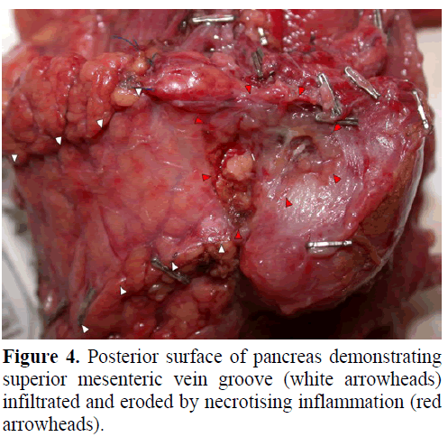 pancreas-posterior-surface-pancreas