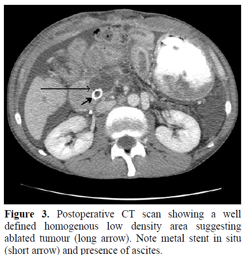 pancreas-postoperative-ct-scan-density