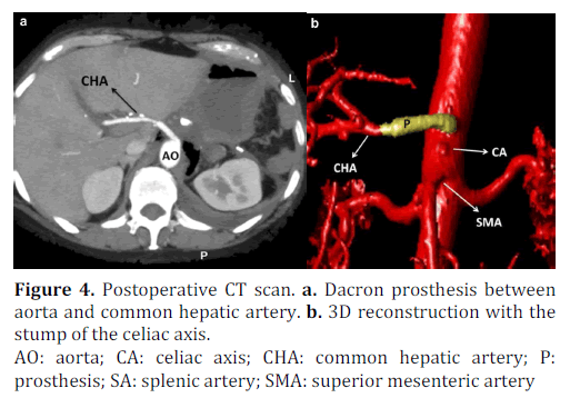 pancreas-postoperative-dacron-prosthesis