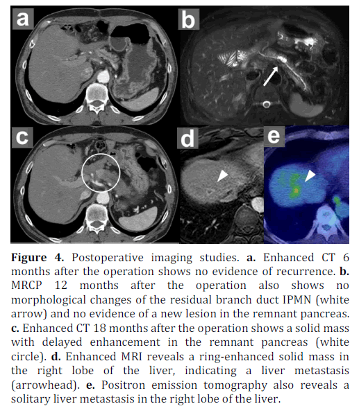 pancreas-postoperative-morphological-residual