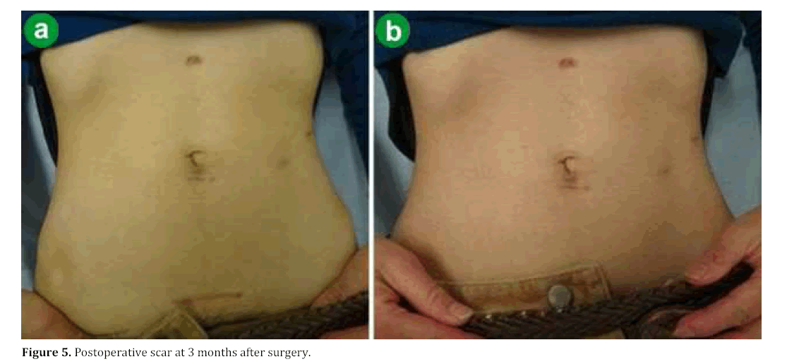 pancreas-postoperative-scar