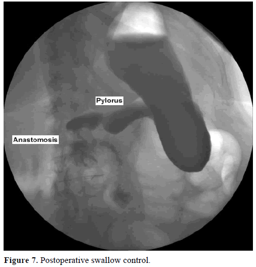 pancreas-postoperative-swallow-control