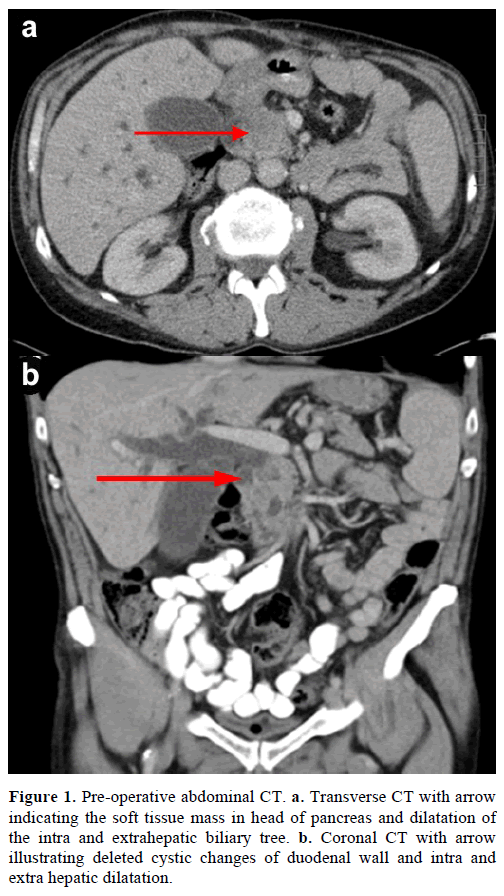 pancreas-pre-operative-abdominal
