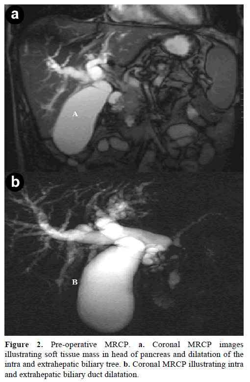 pancreas-pre-operative-mrcp