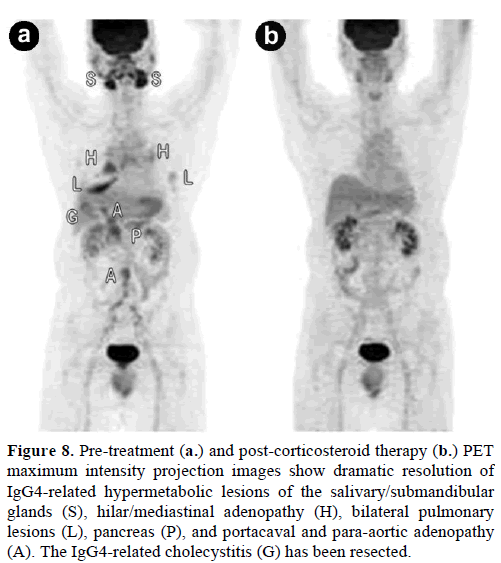 pancreas-pre-treatment-post-corticosteroid