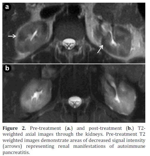 pancreas-pre-treatment-post-treatment