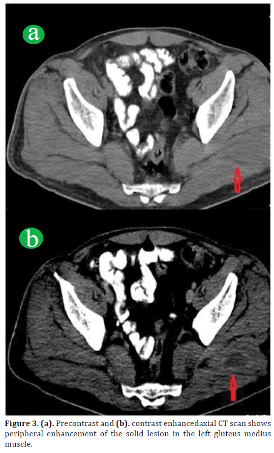 pancreas-precontrast-enhancedaxial