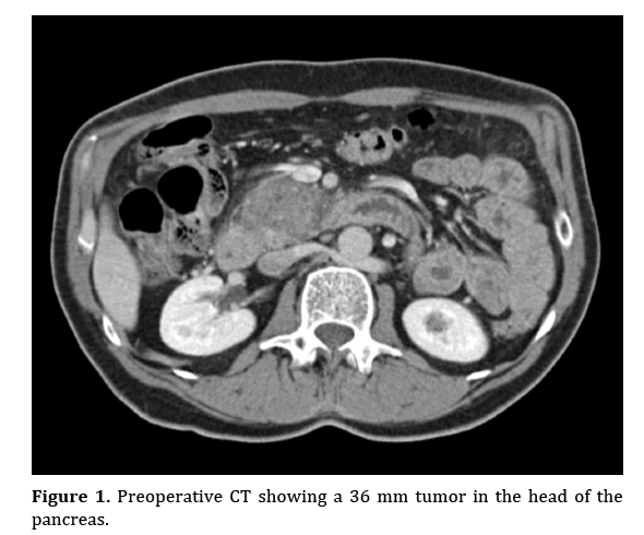 pancreas-preoperative-CT-showing
