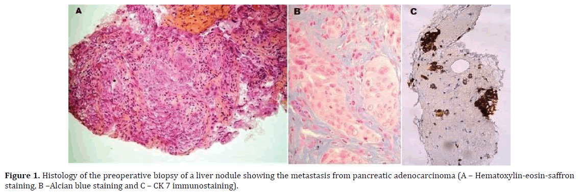 pancreas-preoperative-biopsy