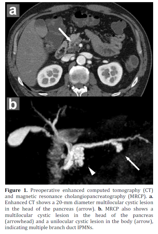 pancreas-preoperative-computed-tomography