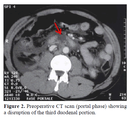 pancreas-preoperative-ct-disruption