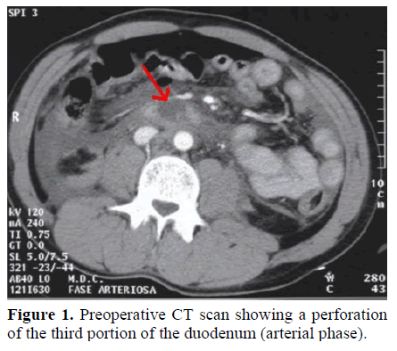 pancreas-preoperative-ct-perforation