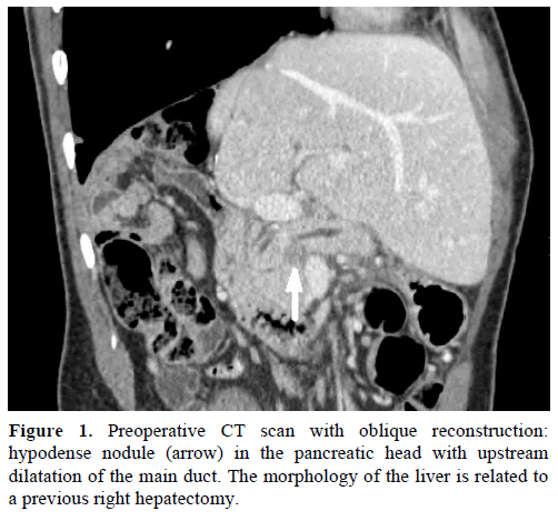 pancreas-preoperative-ct-scan-oblique