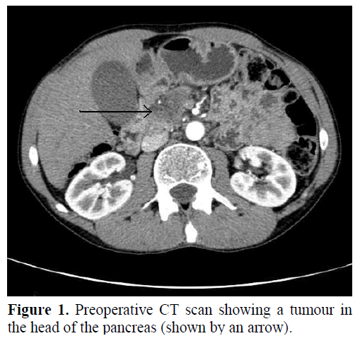 pancreas-preoperative-ct-scan-tumour