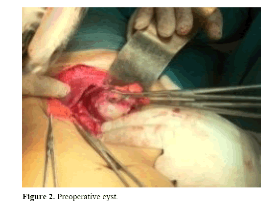 pancreas-preoperative-cyst