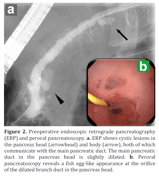 pancreas-preoperative-endoscopic-retrograde