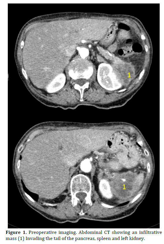 pancreas-preoperative-imaging-abdominal