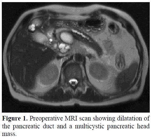 pancreas-preoperative-mri-scan-dilatation