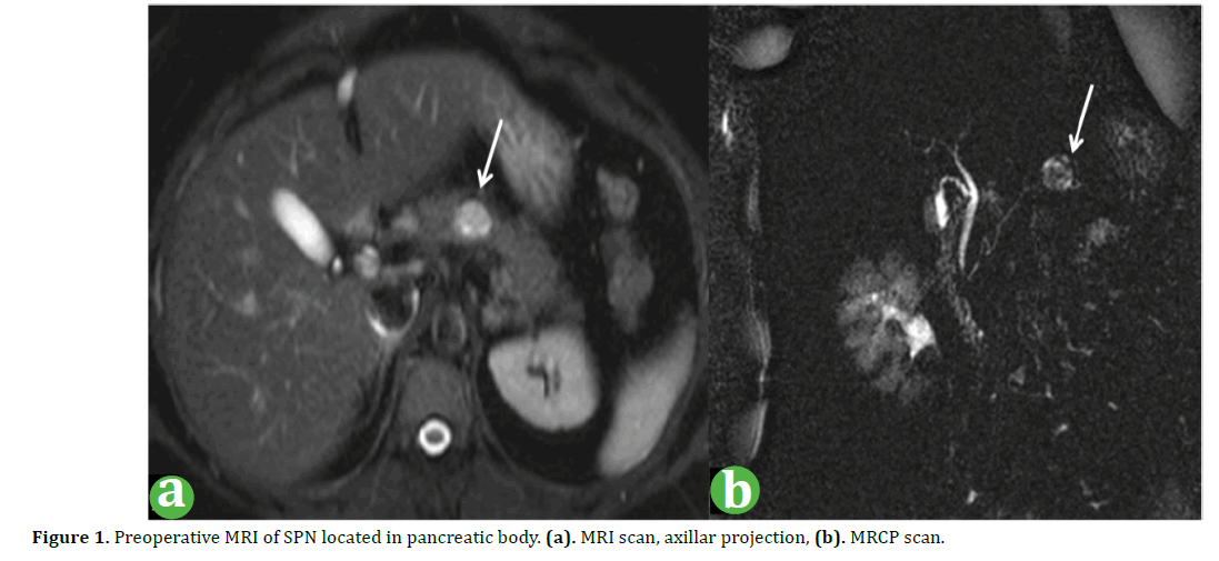 pancreas-preoperative-pancreatic-body