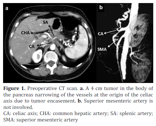 pancreas-preoperative-scan-tumor