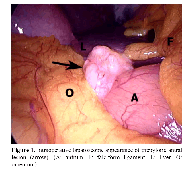 pancreas-prepyloric-antral