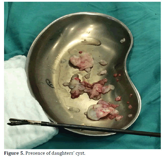 pancreas-presence-daughters-cyst