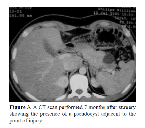 pancreas-presence-pseudocyst-adjacent