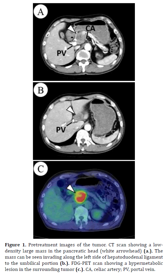 pancreas-pretreatment-tumor-umbilical