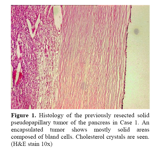 pancreas-previously-resected-solid