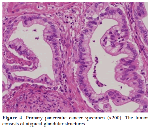 pancreas-primary-pancreatic-cancer