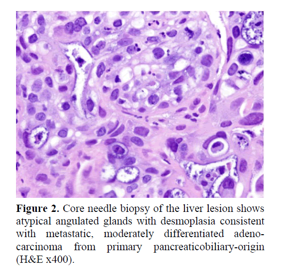 pancreas-primary-pancreaticobiliary-origin
