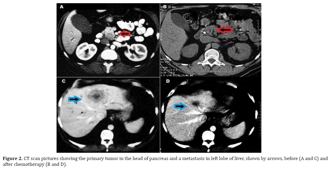 pancreas-primary-tumor