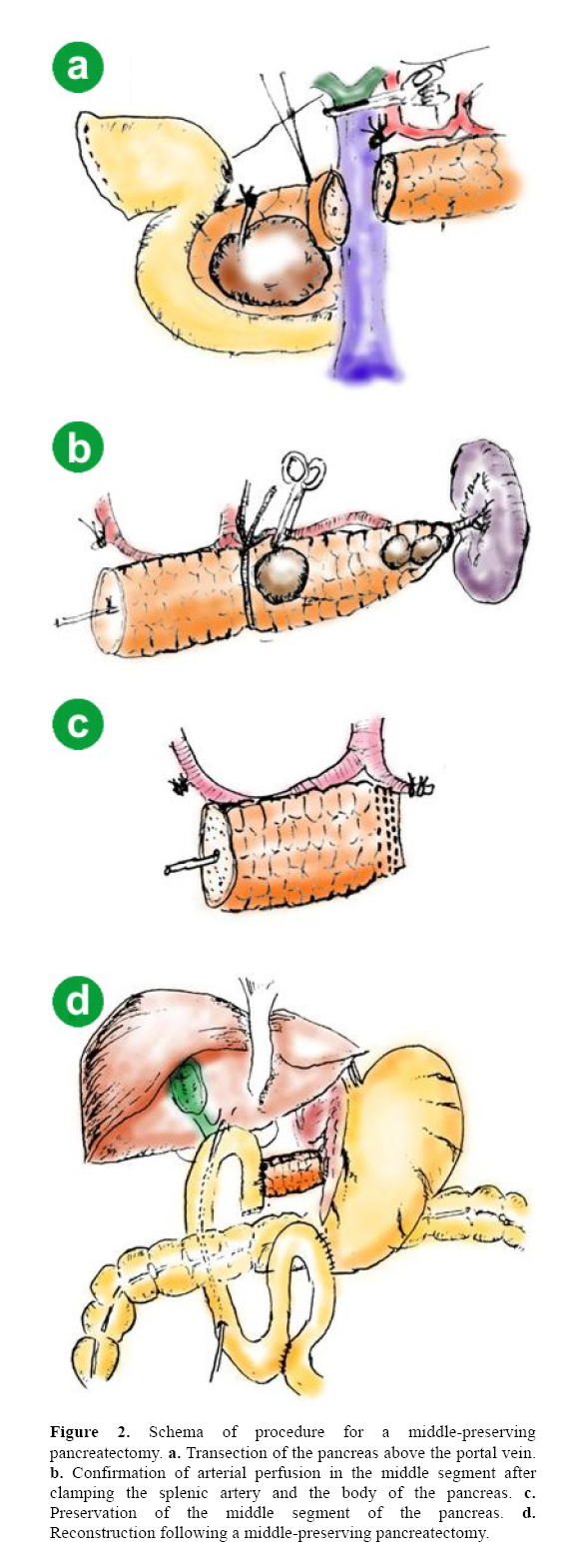 pancreas-procedure-middle-preserving