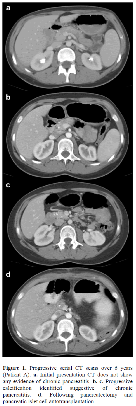 pancreas-progressive-serial-ct-scans