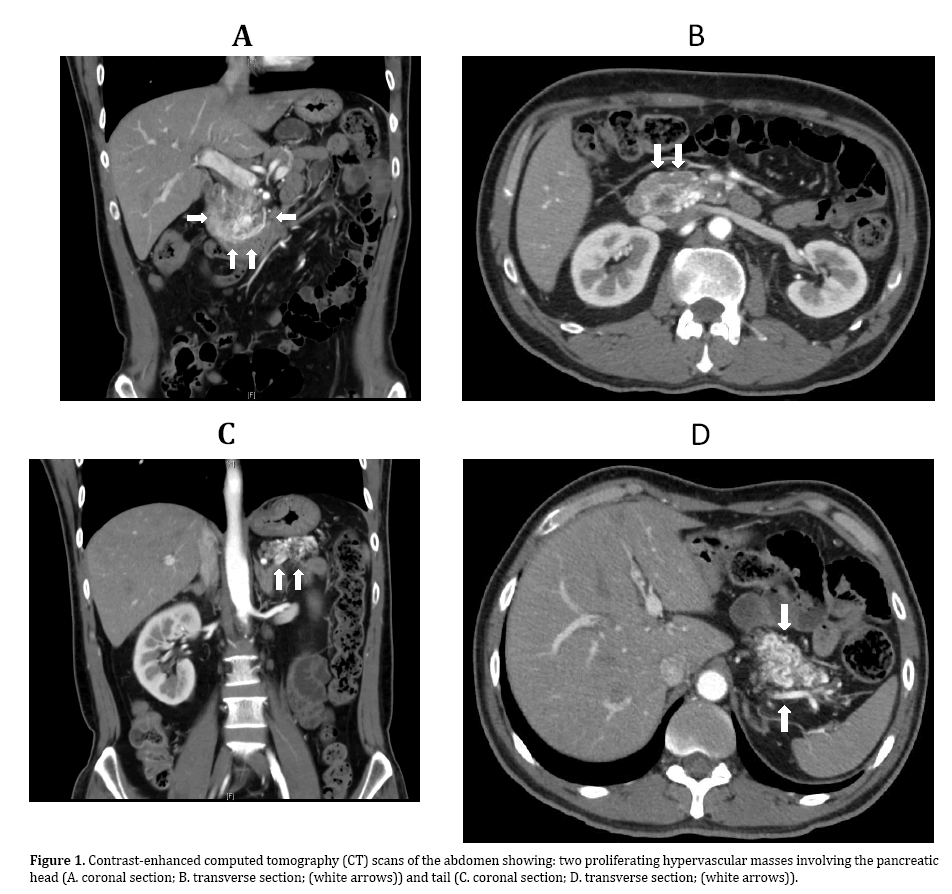 pancreas-proliferating-hypervascular