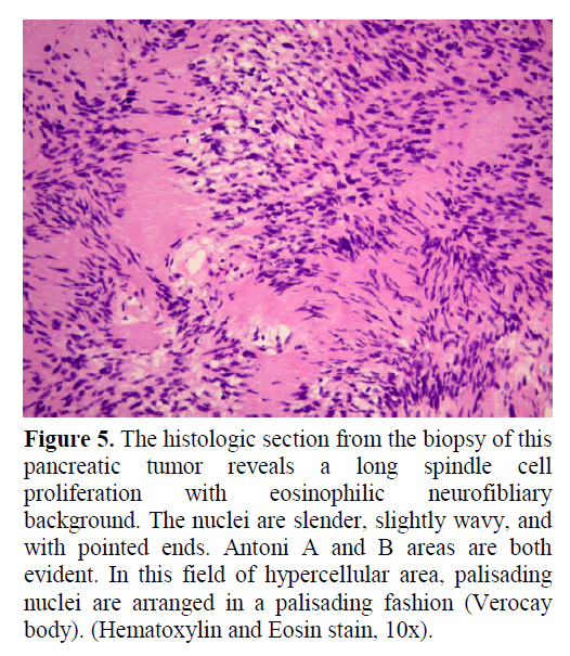 pancreas-proliferation-eosinophilic-neurofibliary