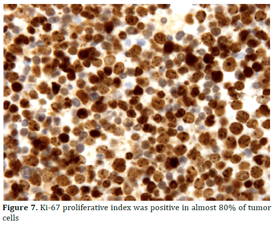 pancreas-proliferative-tumor-cells
