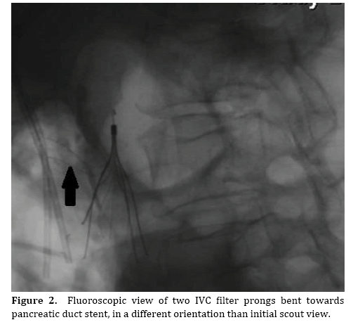 pancreas-prongs