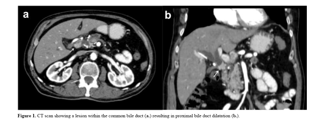 pancreas-proximal-bile-duct-dilatation