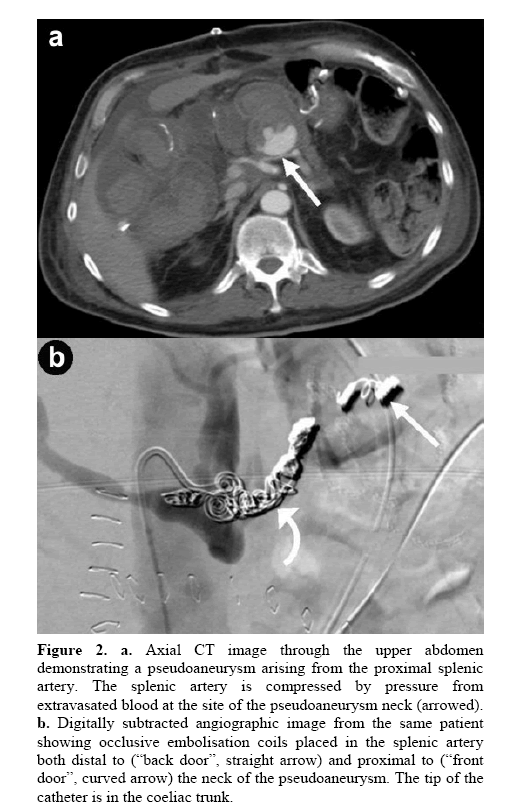 pancreas-proximal-splenic