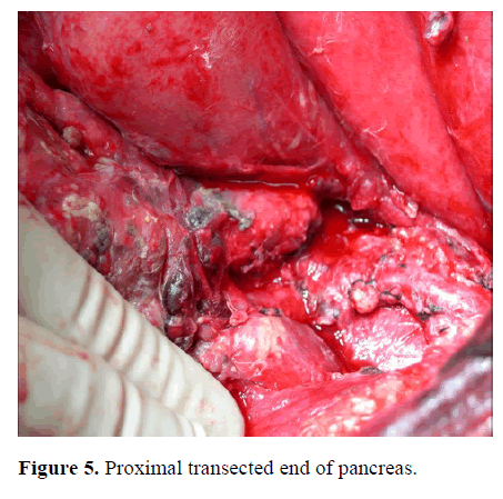 pancreas-proximal-transected-pancreas
