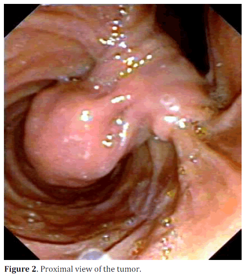 pancreas-proximal-view-tumor