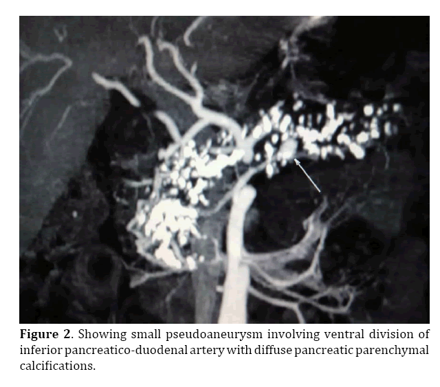 pancreas-pseudoaneurysm