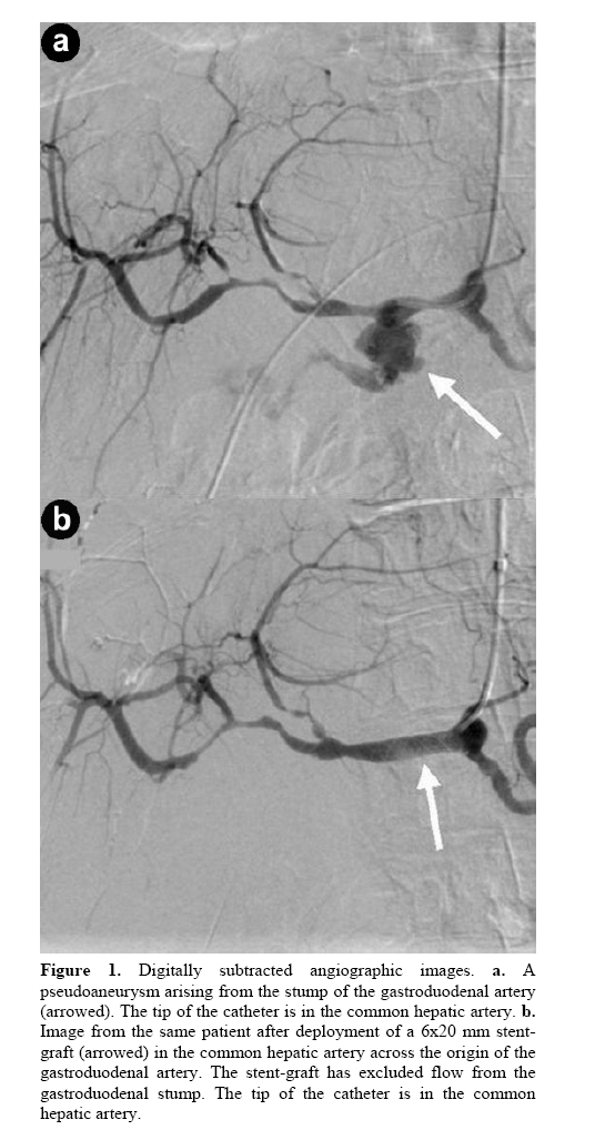 pancreas-pseudoaneurysm-arising