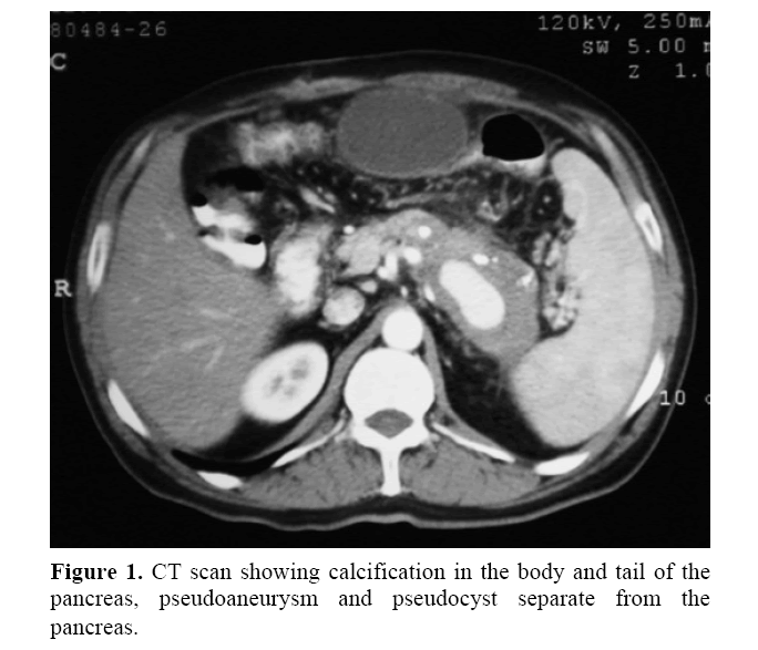 pancreas-pseudoaneurysm-pseudocyst-separate