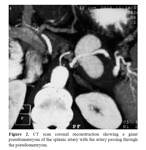 pancreas-pseudoaneurysm-splenic-artery